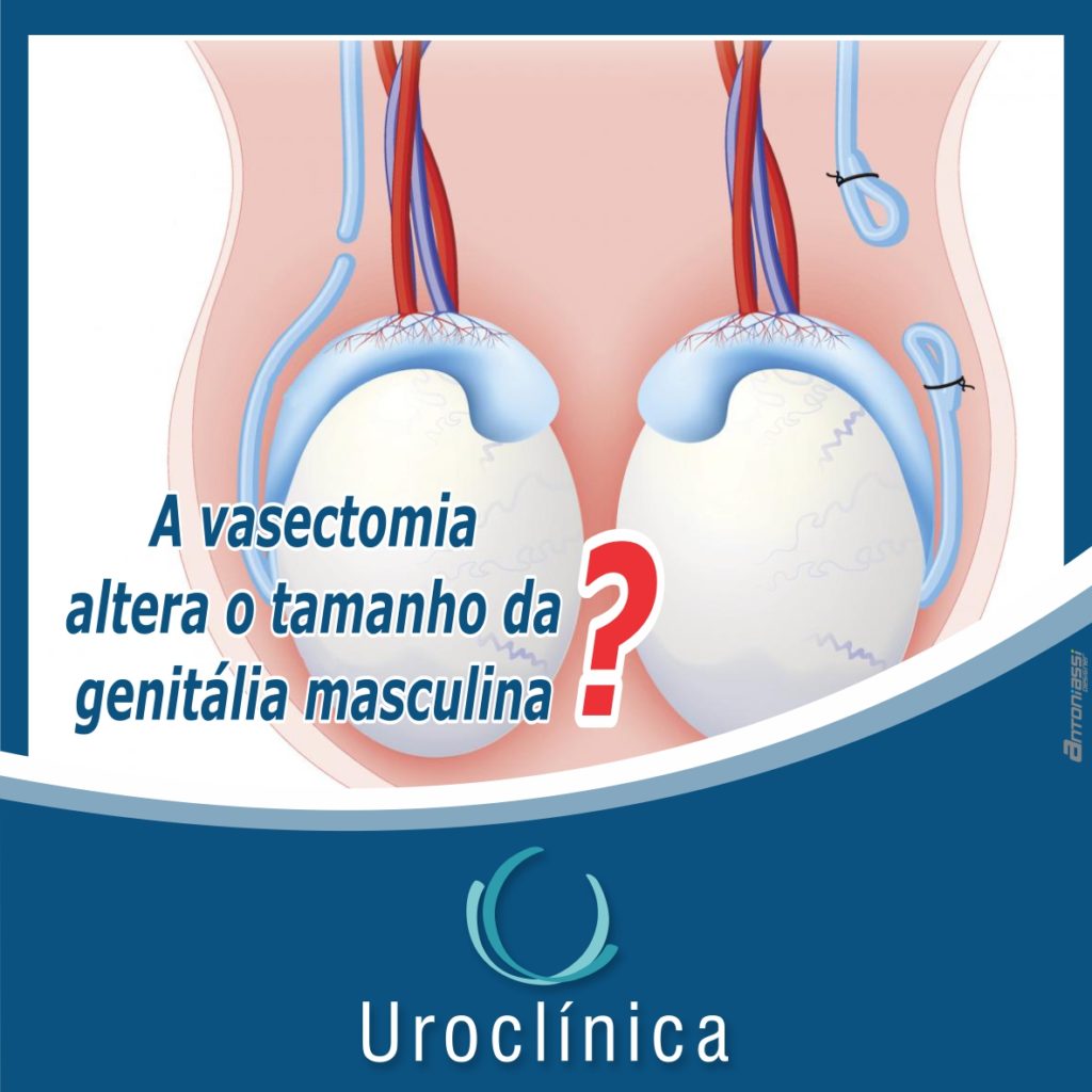 A Vasectomia Altera O Tamanho Da Genit lia Masculina Uroclinica Umuarama